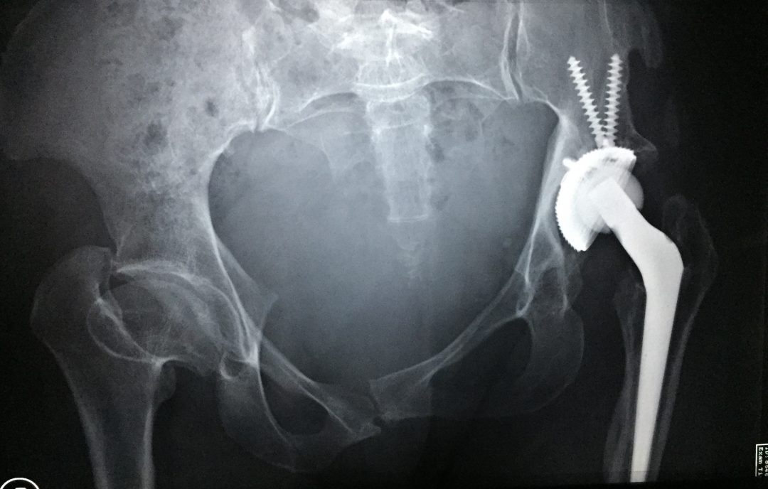 JillPringle Hips Xray DDH hip displaysia