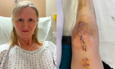 Knee replacement Jill Pringle