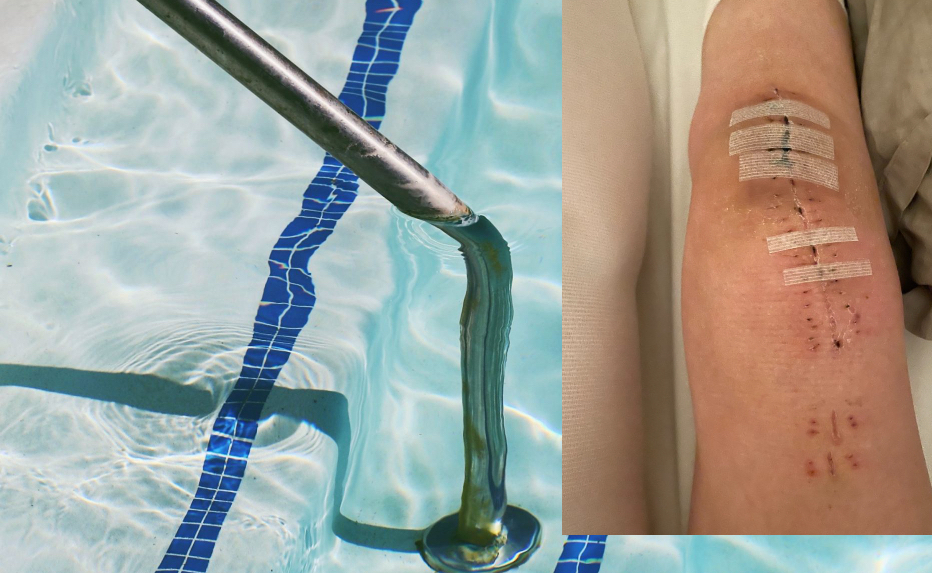 hydrotherapy diff-abled jill pringle knee replacement