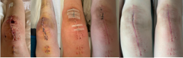 A diary of ‘firsts’ for my two-month-old knee
