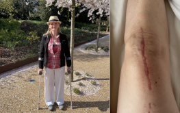 3 months post-op: back to hip rehab to get off crutches