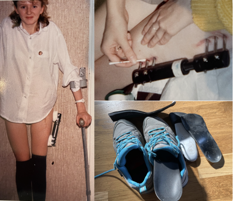 Leglength discrepancy a DDH journey of shoes & surgery Jill's