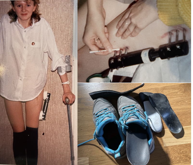 Jill leg length discrepancy surgery and orthotics