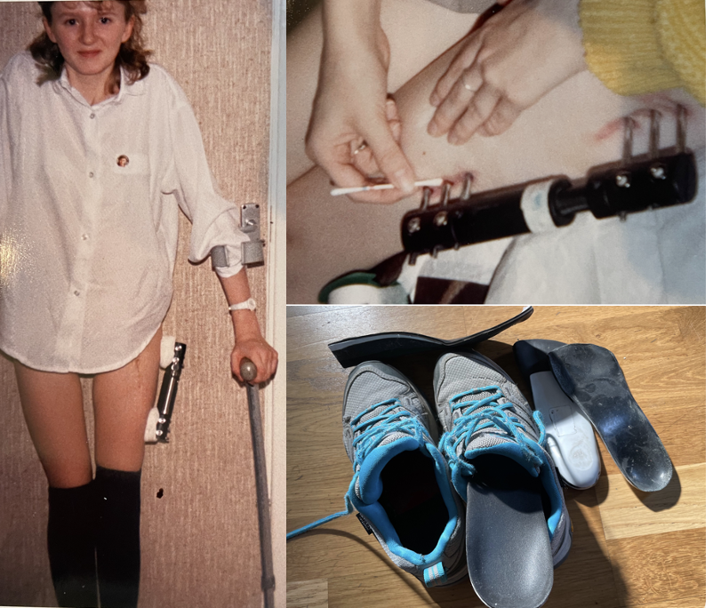 Leg-length discrepancy – a DDH journey of shoes & surgery : Jill's ...