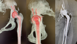 CT scans X Rays prior to hip revision surgery
