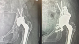 Hip Xray Jill Hip revision and replacement