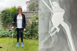 jill pringle in knee brace and hip revision xray